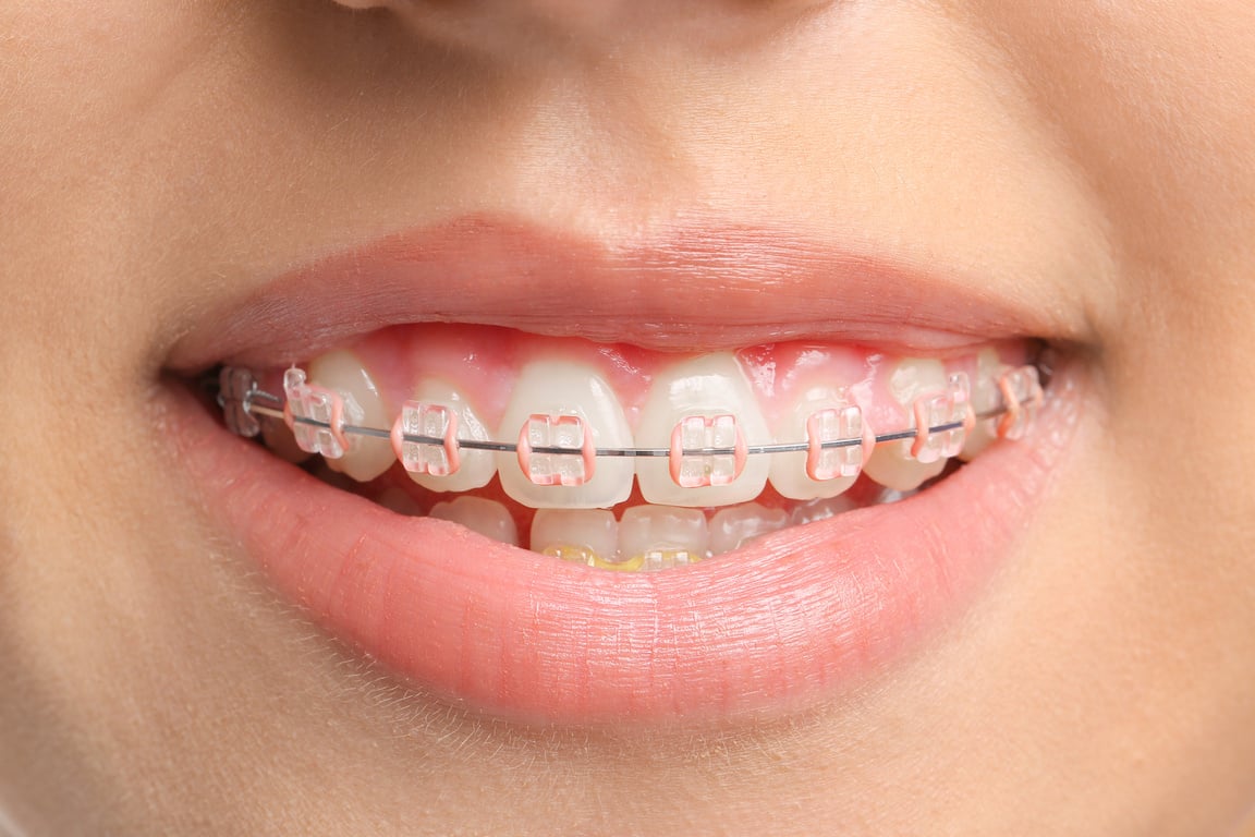 Teeth of Young Woman with Dental Braces, Closeup